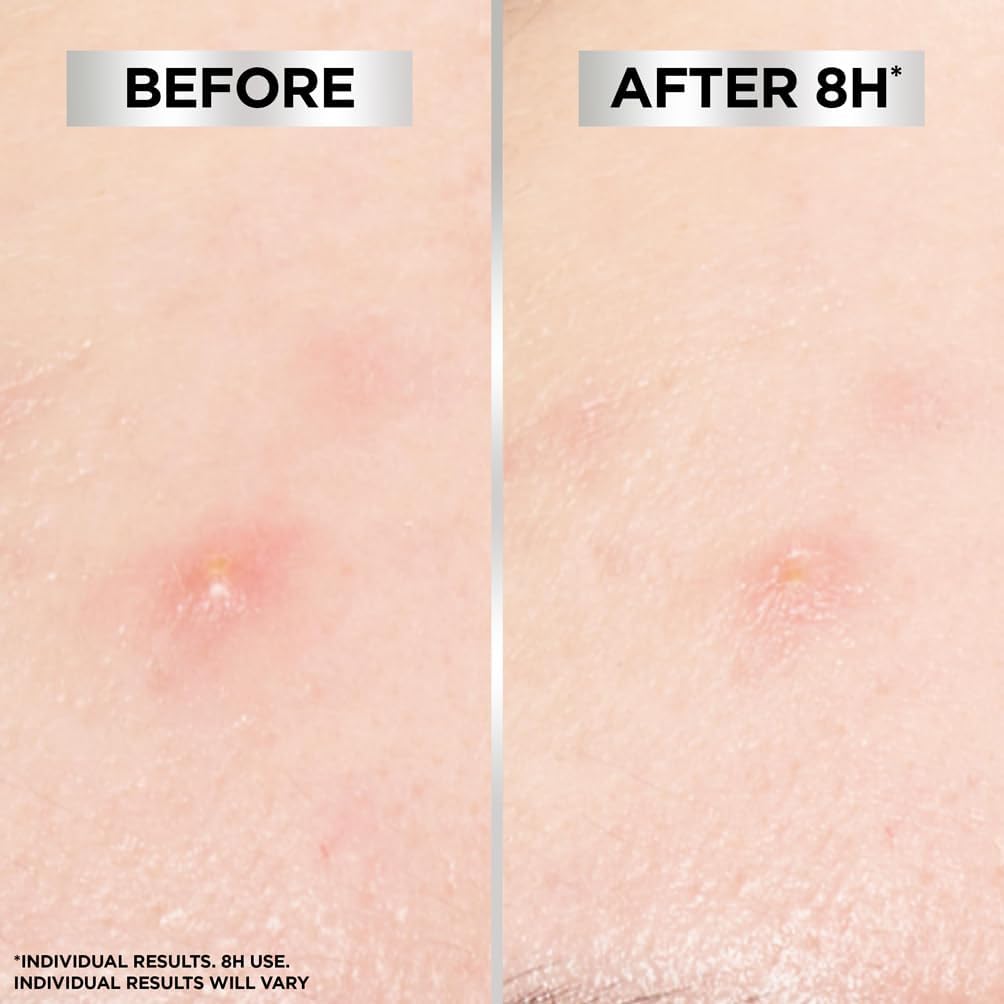 Garnier Blemish Patches, Hydrocolloid patches to reduce the appearance of spots in 8 hours, Ultra-thin & Invisible on all skin tones, Suitable For All Skin Types, Vegan Formula, 22 Patches